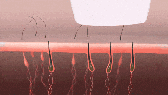 两种脱毛仪-808orOPT，你会如何选