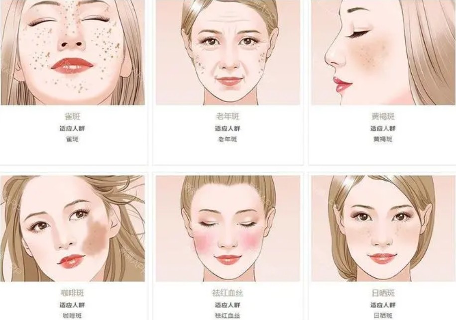 激光美容适宜人群